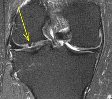 Figure 6 for case Button osteophyte filling chondral defect